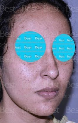 Rhinoplasty: Minimal changes to have a great nose - Before