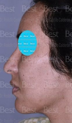 Rhinoplasty: Minimal changes to have a great nose - Before