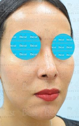 Rhinoplasty: Minimal changes to have a great nose - After