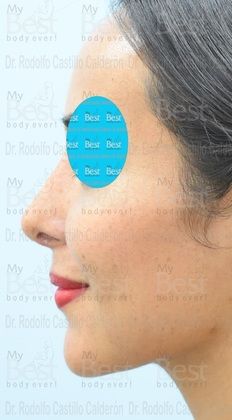 Rhinoplasty: Minimal changes to have a great nose - After