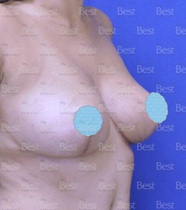 Breast Reduction: Woman that wants less Breast volume - After