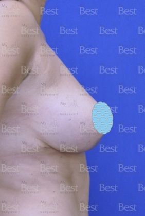 Breast Reduction: Woman that wants less Breast volume - After
