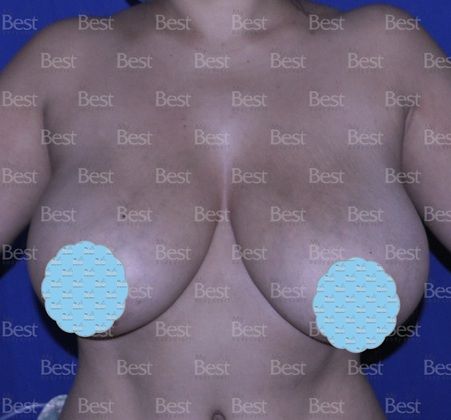 Breast Reduction: Woman that wants less Breast volume - Before