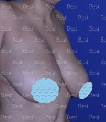 Breast Reduction: Woman that wants less Breast volume - Before