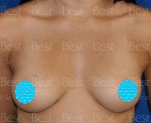 Breast Augmentation Patient with 500 cc silicon gel filled implants - Before