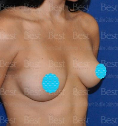 Breast Augmentation: Patient with 500 cc silicon gel filled implants - Before