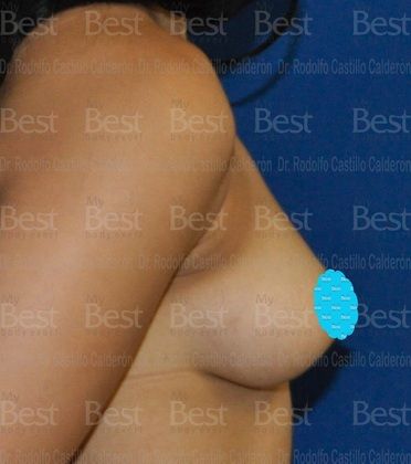 Breast Augmentation: Patient with 500 cc silicon gel filled implants - Before