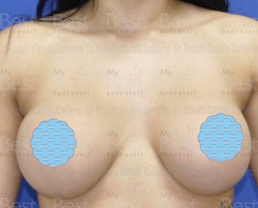 Breast Augmentation Patient with 500 cc silicon gel filled implants - After