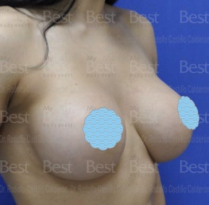 Breast Augmentation: Patient with 500 cc silicon gel filled implants - After