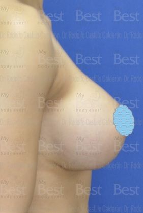 Breast Augmentation: Patient with 500 cc silicon gel filled implants - After