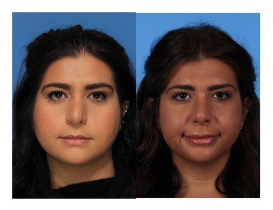 Revision Rhinoplasty : Case 2