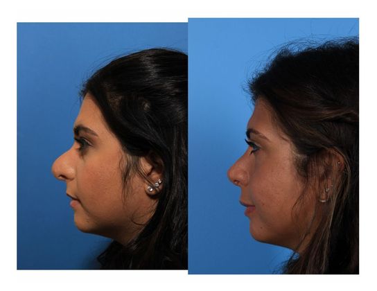 Revision Rhinoplasty : Case 2