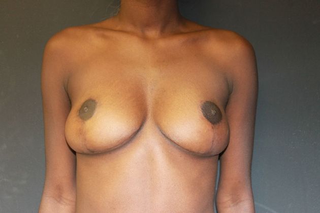 Breast Reduction Case 14 - After