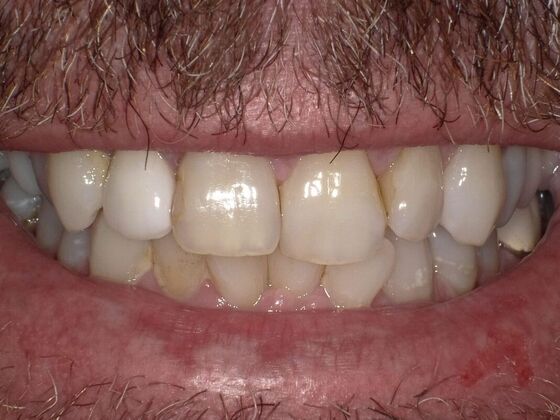 Smile Design Case 4 - Before