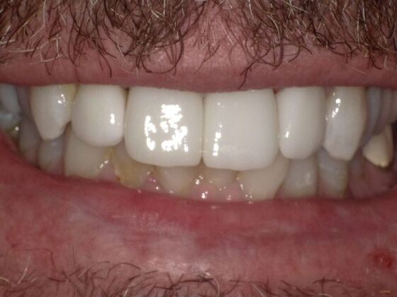 Smile Design Case 4 - After