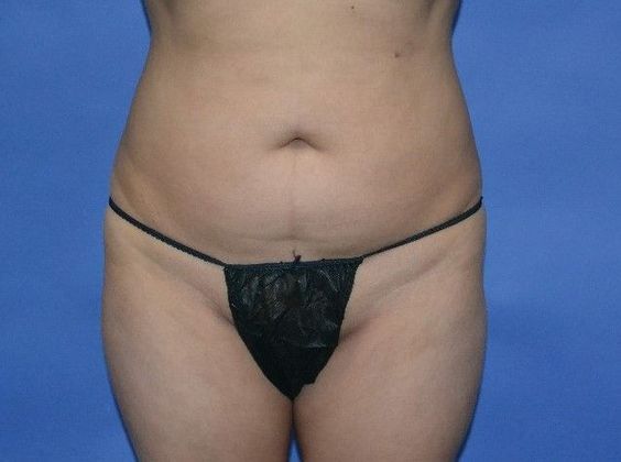 Brazilian Butt Lift: 44yo pt BBL 840CC harvested fat injected in each buttock. - Before