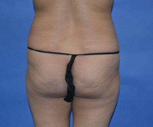Brazilian Butt Lift: 44yo pt BBL 840CC harvested fat injected in each buttock. - Before