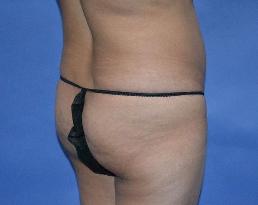 Brazilian Butt Lift: 44yo pt BBL 840CC harvested fat injected in each buttock. - Before
