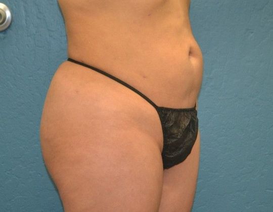 Brazilian Butt Lift: 44yo pt BBL 840CC harvested fat injected in each buttock. - After