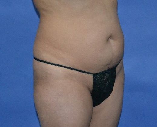 Brazilian Butt Lift: 44yo pt BBL 840CC harvested fat injected in each buttock. - Before