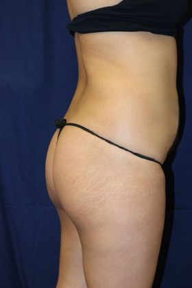 Brazilian Butt Lift : Case 2 - Before