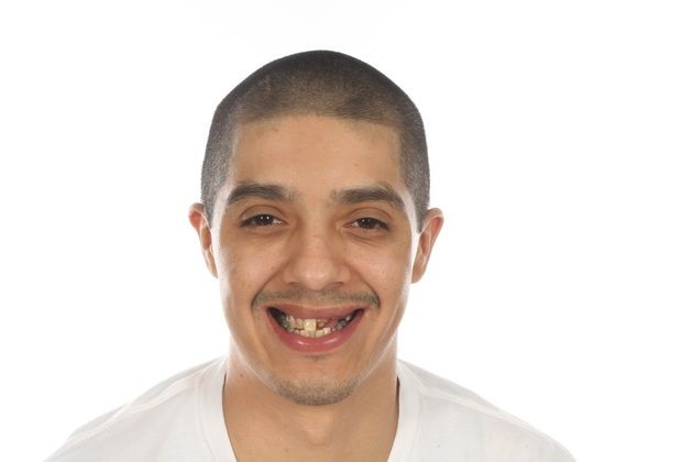 All on 4 Dental Implants Case 7  - Before