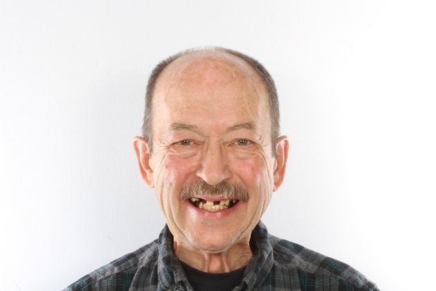 All on 4 Dental Implants Case 3  - Before