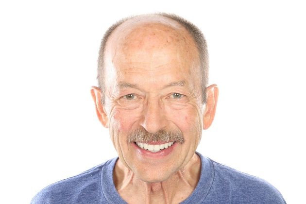 All on 4 Dental Implants Case 3  - After