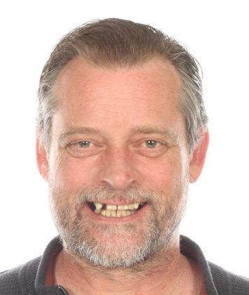 All on 4 Dental Implants Case 1  - Before