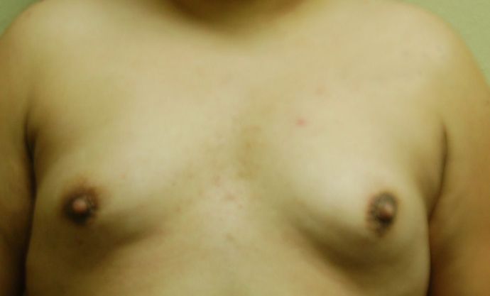 Breast Augmentation Case 523 - Before