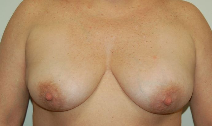 Breast Augmentation w/ Lift Case 247 - Before