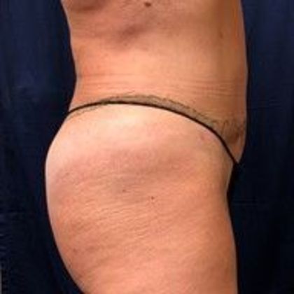 Brazilian Butt Lift : Case 15 - After