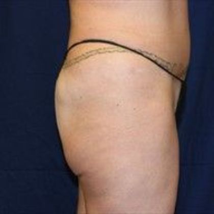 Brazilian Butt Lift : Case 15 - Before