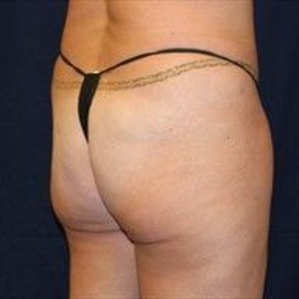 Brazilian Butt Lift : Case 15 - Before