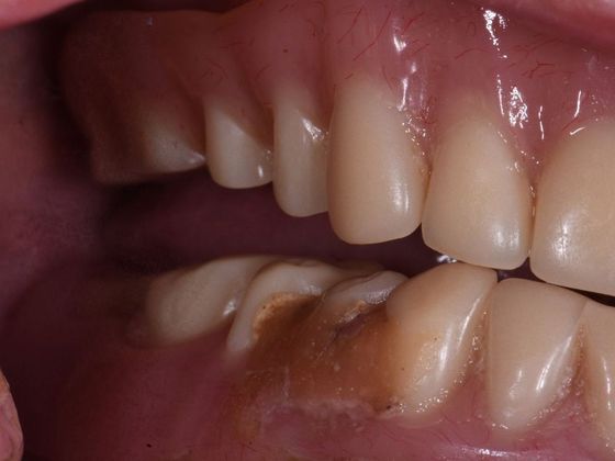 Traditional Dentures: Case 3 - Before