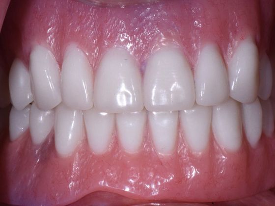 Traditional Dentures: Case 3 - After