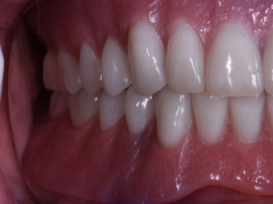 Traditional Dentures: Case 3 - After