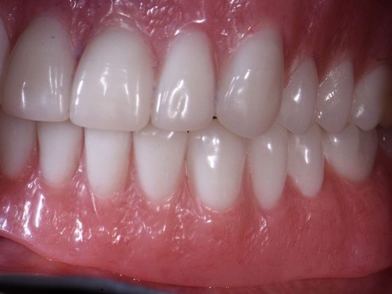 Traditional Dentures: Case 3 - After