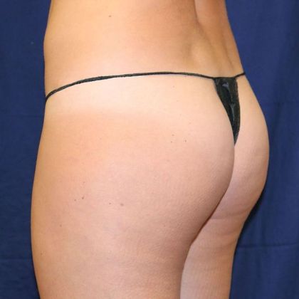 Brazilian Butt Lift Reno, NV - Murphy Plastic Surgery & Medical Spa