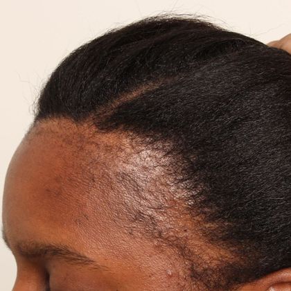 Ayurvedic Herbal Treatment of Hair Loss Hair Fall Alopecia in Adelaide