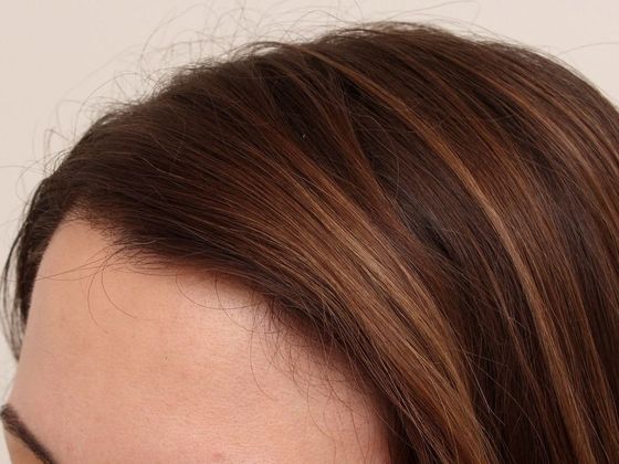 Hair Transplant - Female: Hairline FUT (3) - After female FUT hair transplant