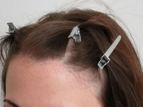 Hair Transplant - Female: Hairline FUT (3) - Before female FUT hair transplant