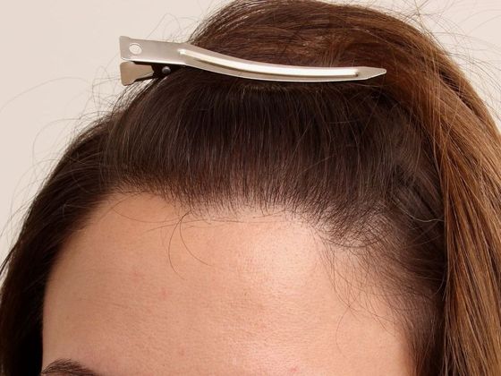 Hair Transplant - Female: Hairline FUT (3) - Female hairline after FUT hair transplant