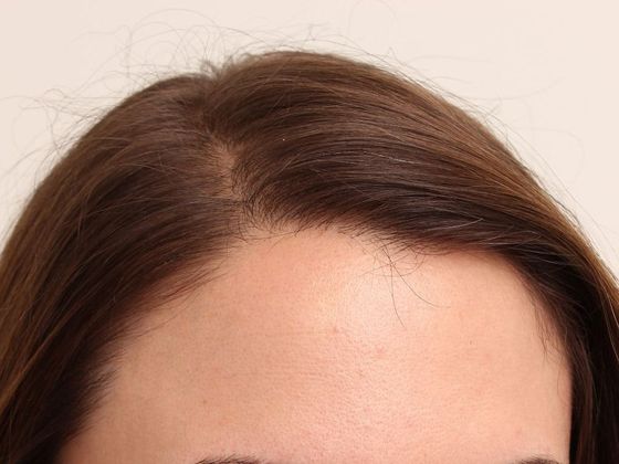Hair Transplant - Female: Hairline FUT (3) - After female FUT hair transplant