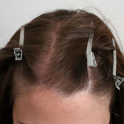 Hair Transplant - Female: Hairline FUT (3) - Before female FUT hair transplant