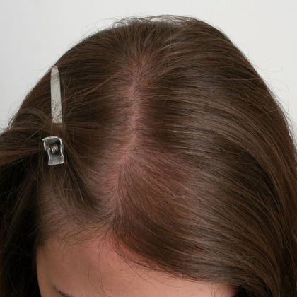 Hair Transplant - Female: Hairline FUT (3) - Before female FUT hair transplant