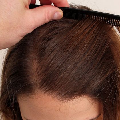 Hair Transplant - Female: Hairline FUT (3) - Female hairline after FUT hair transplant