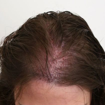 Hair Transplant - Female: Hairline FUT (3) - Immediately post-op female FUT hair transplant