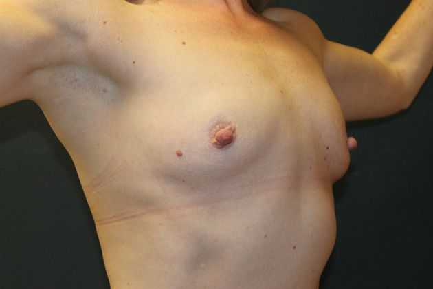 Breast Augmentation Case 24 - Before