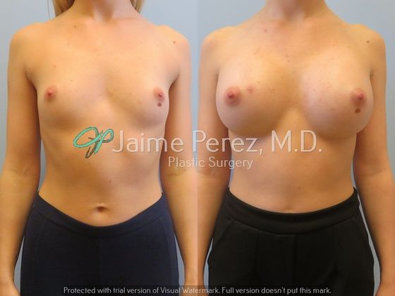 Breast Augmentation: 24 year-old Female: Breast Augmentation - Before & After